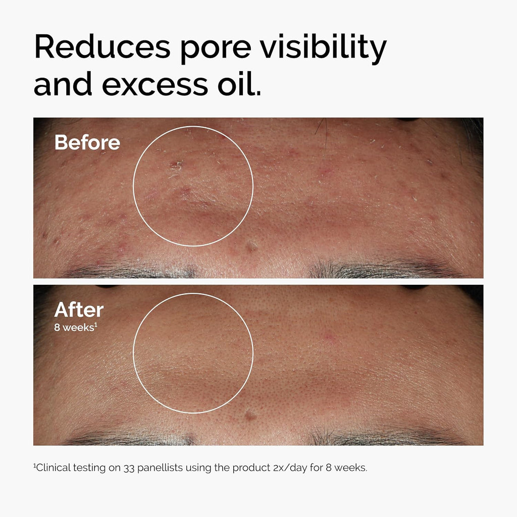 The Ordinary Niacinamide 10% + Zinc 1%, Smoothing Serum for Blemish-Prone Skin